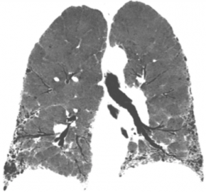 fibrosis pulmonar idiopatica