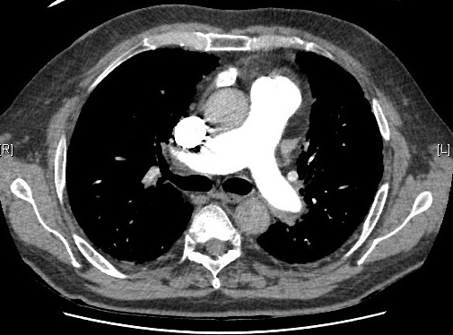 HIPERTENSION PULMONAR