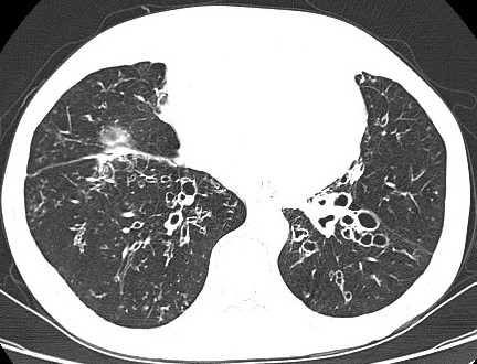 bronquiectasias