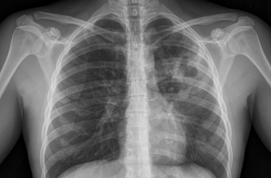 tuberculosis